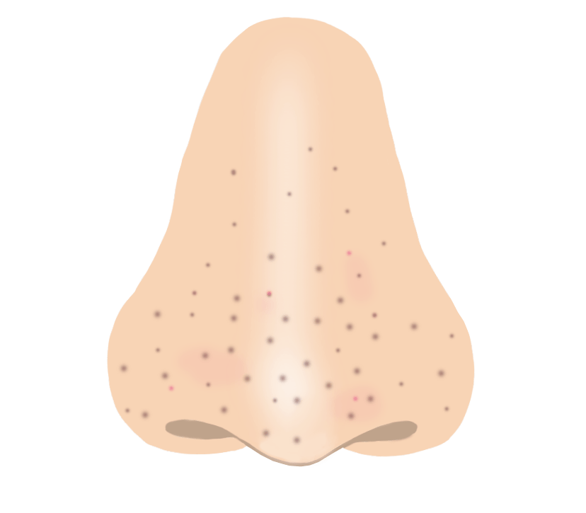 イチゴ鼻のイラスト